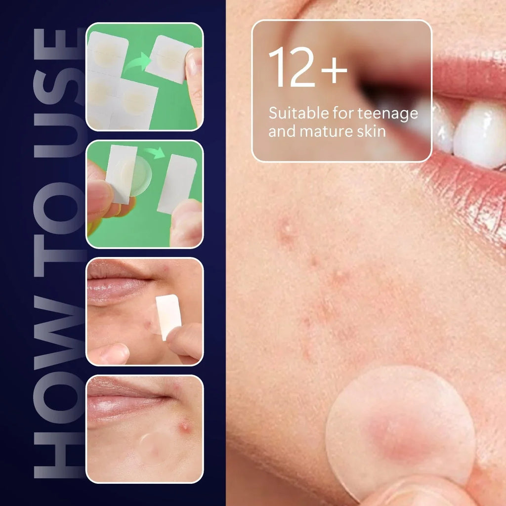 Hydrocolloid Acne Patches 24/48 Pack – Waterproof & Breathable