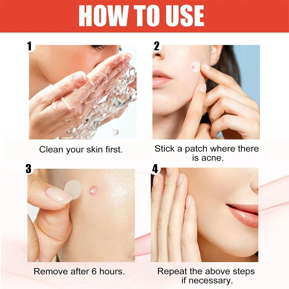 240pcs Salicylic Acid Acne Patches – Star & Heart Pimple Dots