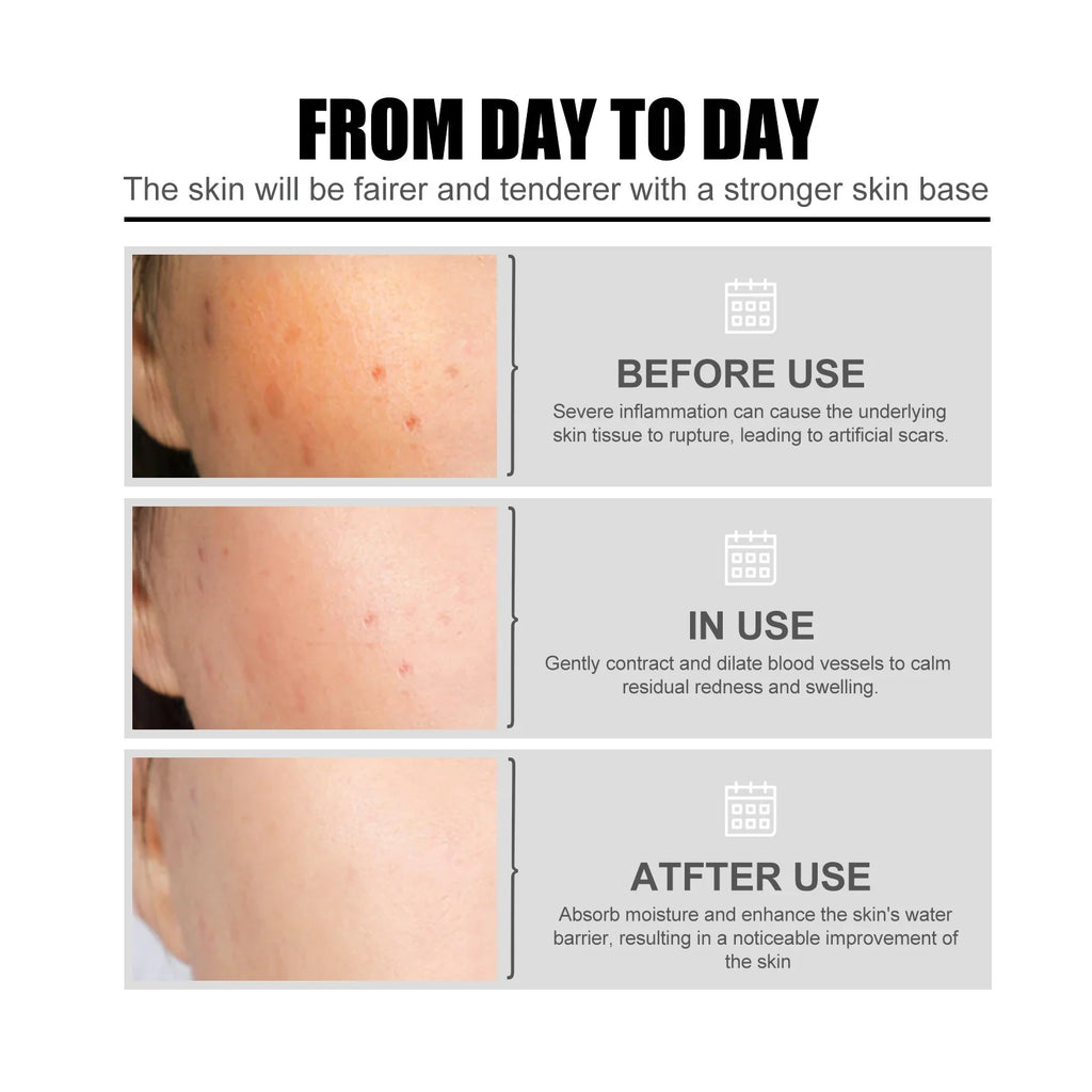 Eelhoe Niacinamide Serum – Fades Acne Marks & Brightens Skin
