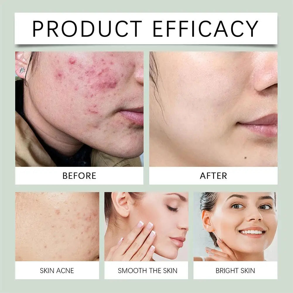 Salicylic Acid Acne Treatment Face Serum Repair Pimple Spots Deep