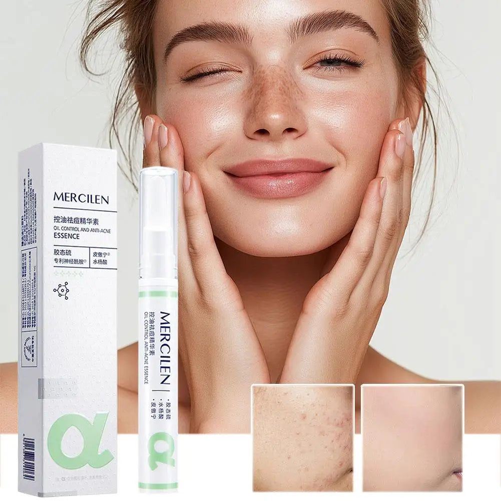 Salicylic Acid Acne Treatment Face Serum Repair Pimple Spots Deep