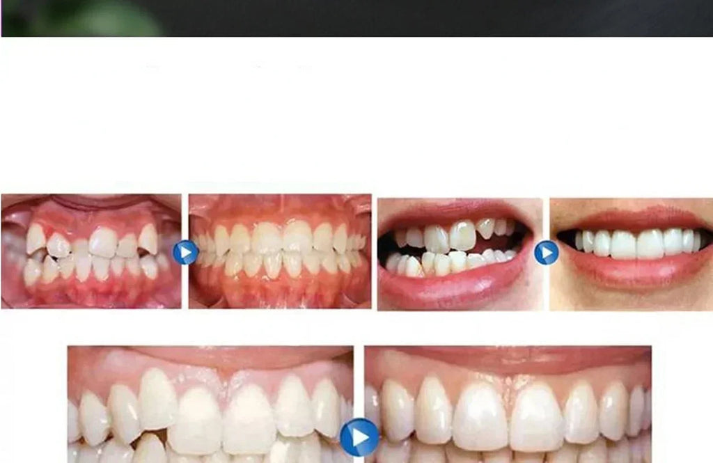Silicone Mouth Guard & Teeth Alignment Trainer | Night Guard