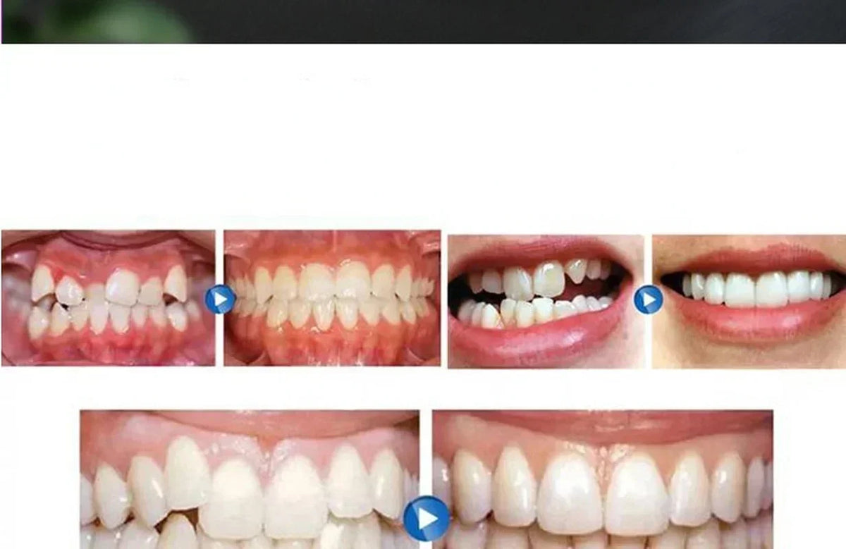 Silicone Mouth Guard & Teeth Alignment Trainer | Night Guard