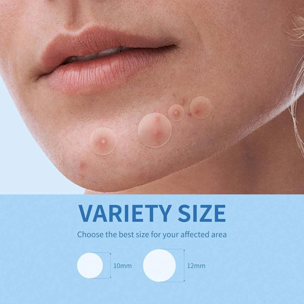 Hydrocolloid Acne Patches 36/360 Pcs – Alcohol-Free Blemish Dots