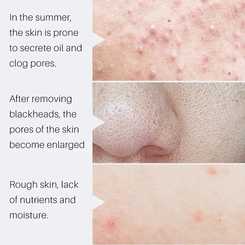 Salicylic Acid Pore Shrinking Serum | Blackhead & Acne Serum