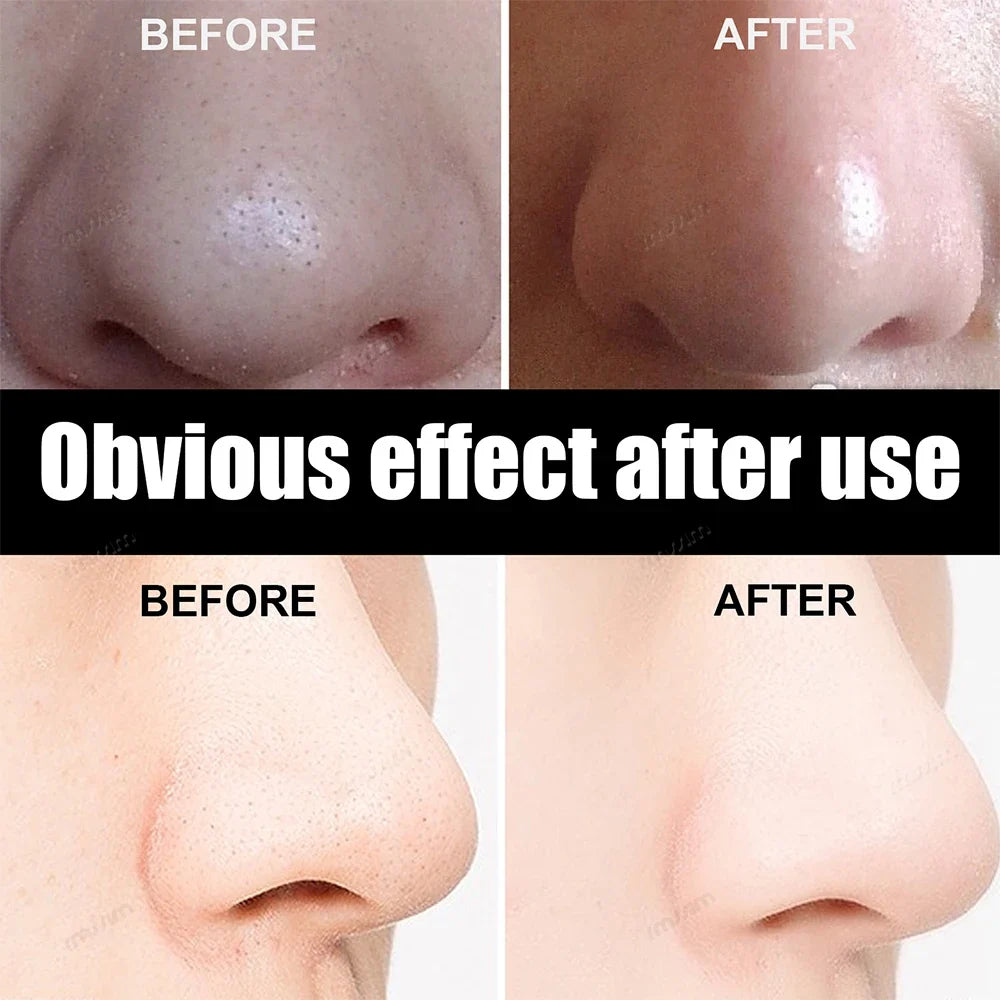 Blackhead Remover Nose Strips – Peel-Off Pore Cleansing Mask