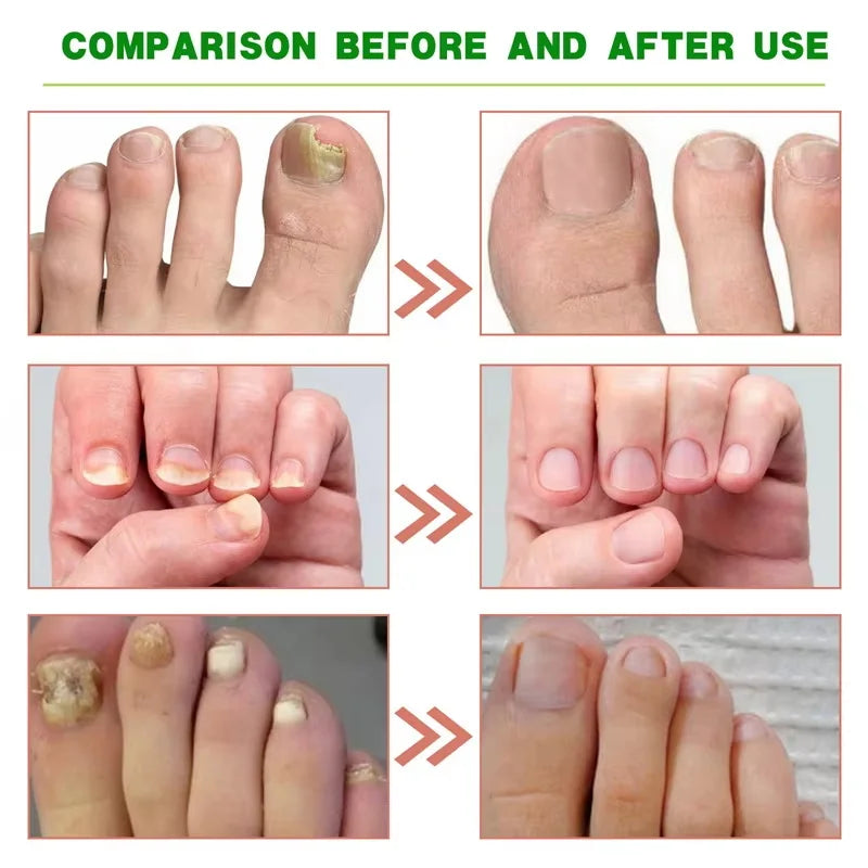 Ginger Nail Repair Serum – Restore Discolored & Uneven Nails