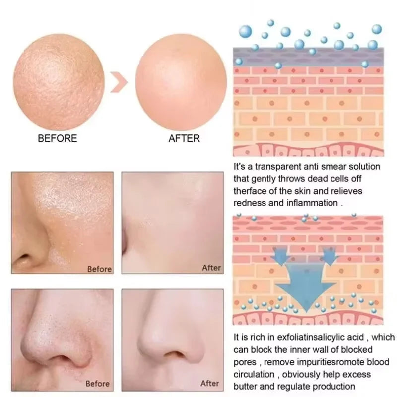 Salicylic Acid Pore Shrinking Serum | Blackhead & Acne Serum