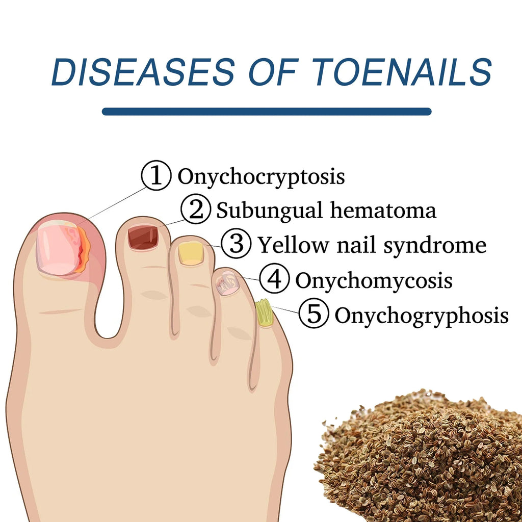 32-Piece Ingrown Toenail Correction Patches & Nail Repair Stickers
