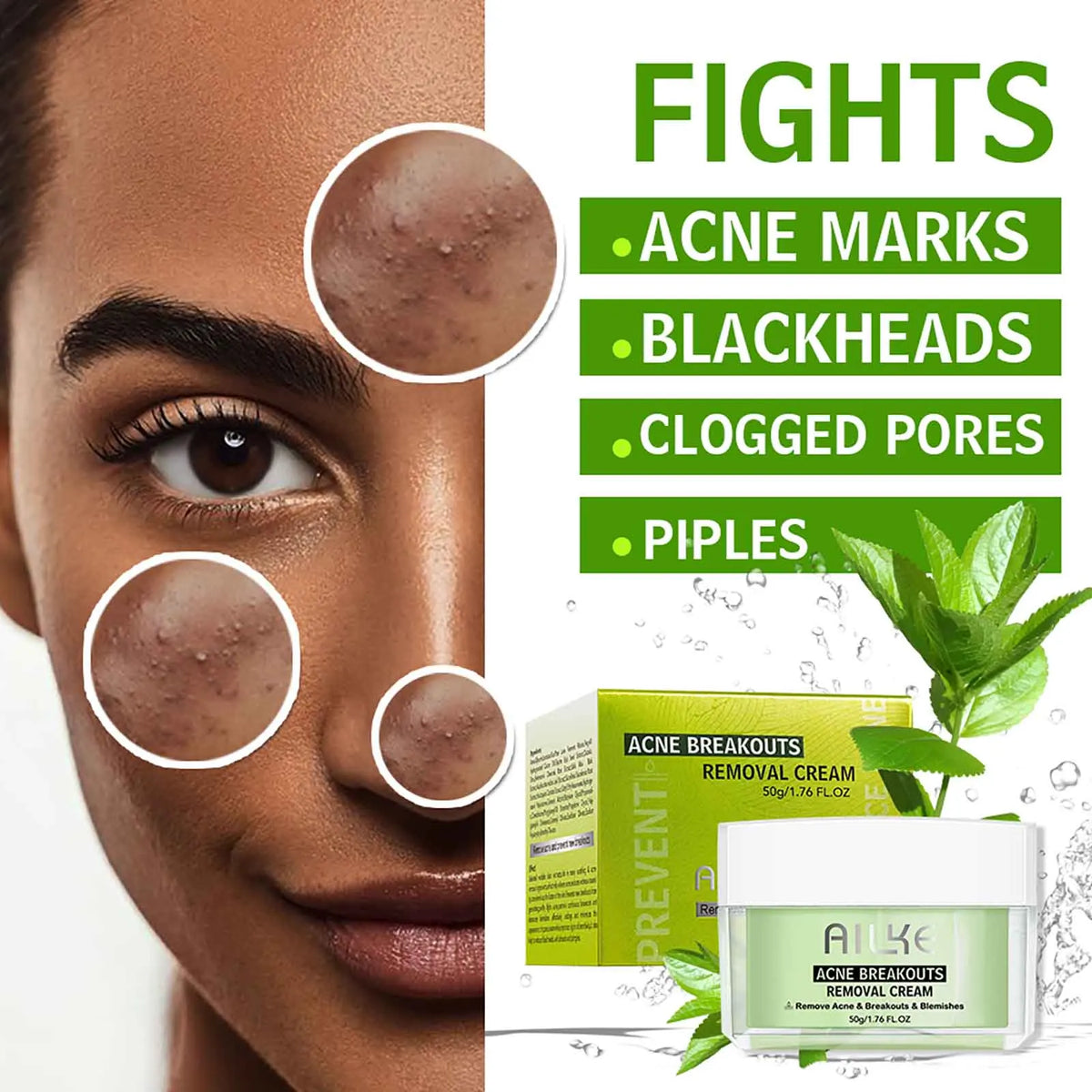 AILKE Acne Face Cream – Clear Skin, All Types | 50ml