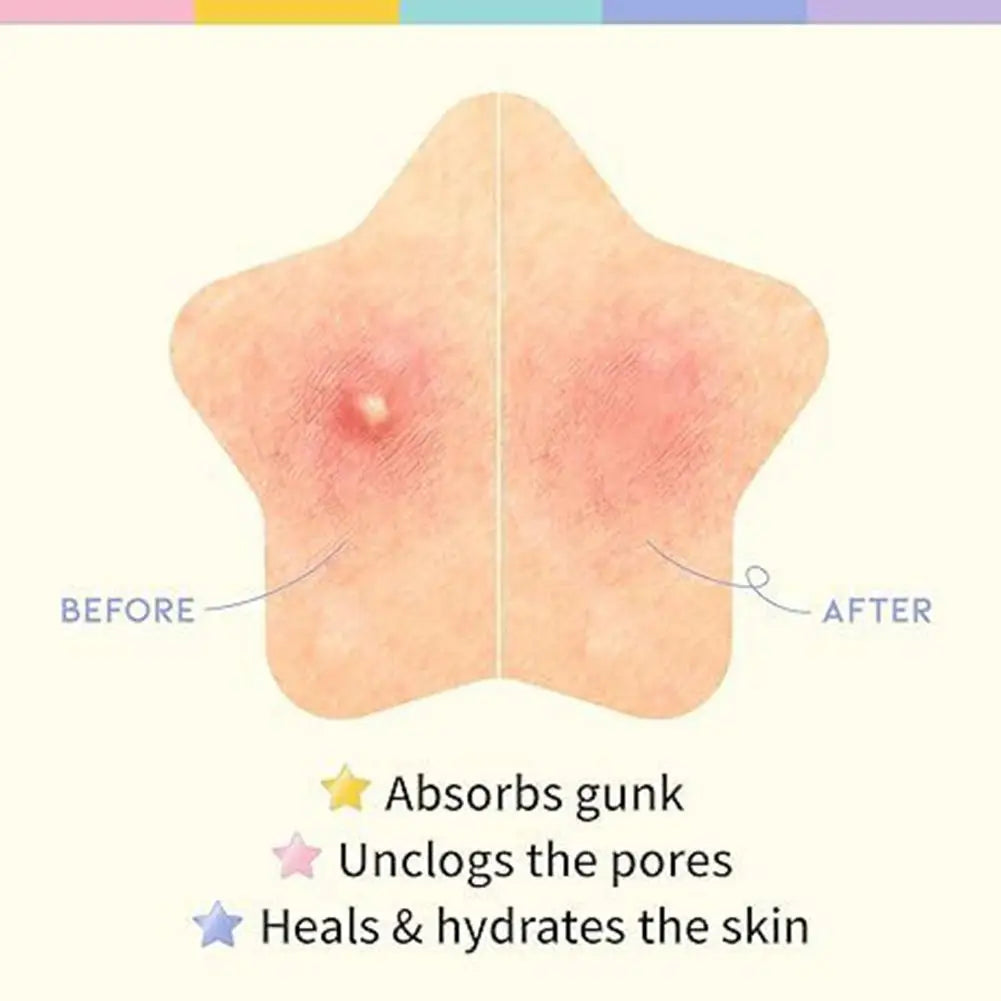 Hydrocolloid Pimple Patches 200/240pcs – Invisible Spot Stickers