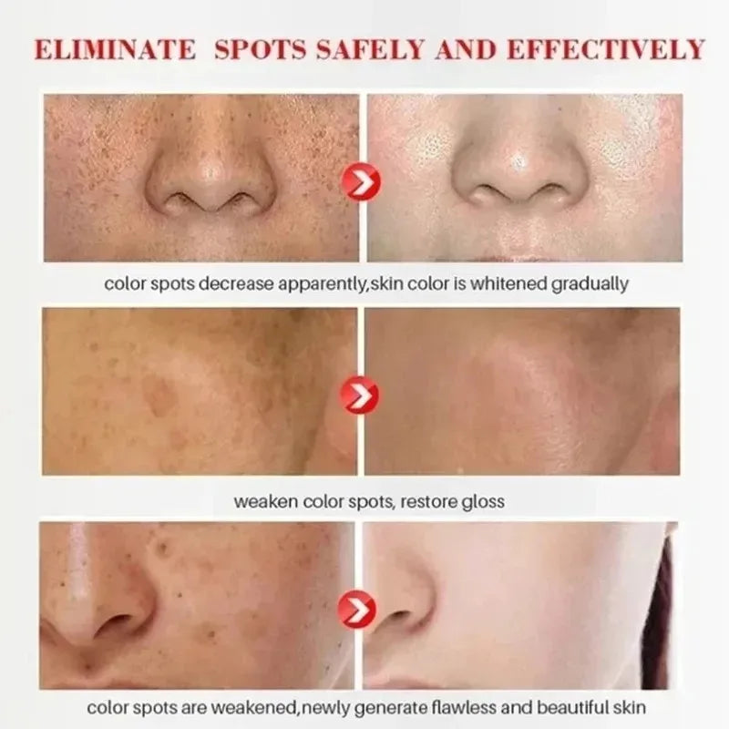 Whitening Freckle Cream Remove Dark Spots Anti Face Creams