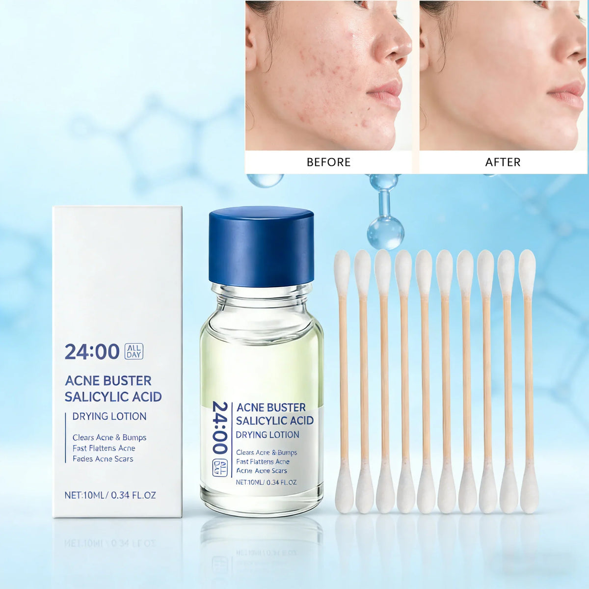 Hoygi Salicylic Acid Acne Serum – Pores, Blackheads & Oil