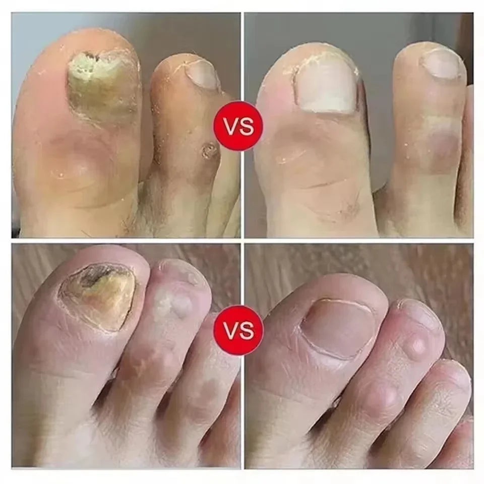 Nail Repair Serum – Foot & Toe Nail Restoration Oil