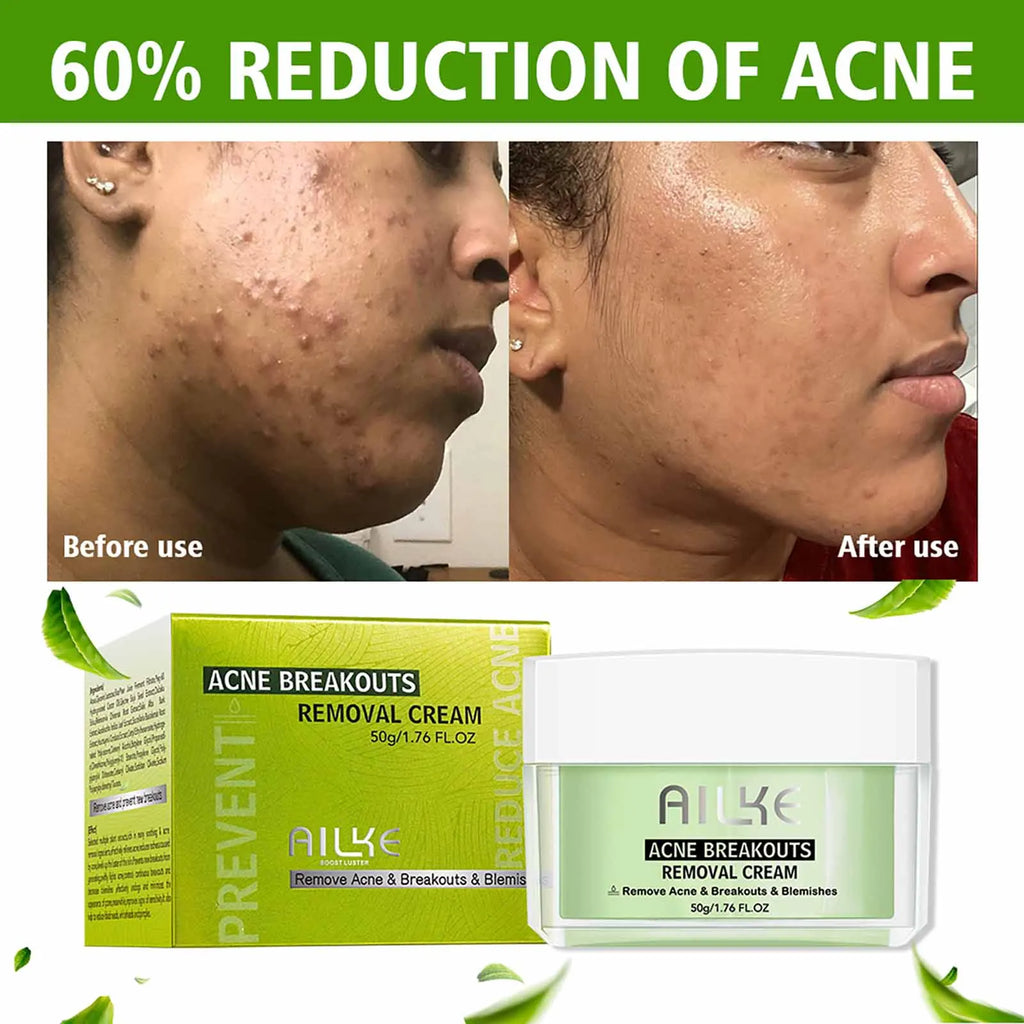AILKE Acne Face Cream – Clear Skin, All Types | 50ml
