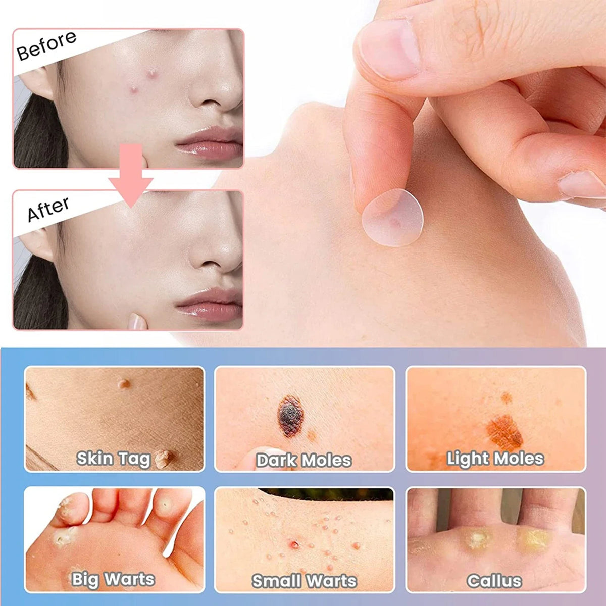 72-Piece Hydrocolloid Acne Patches – Invisible Waterproof Dots