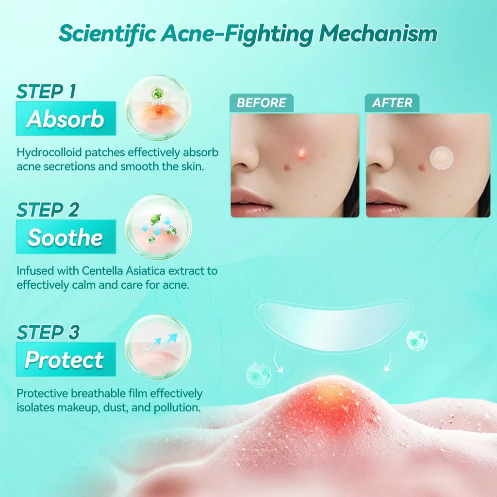 LANBENA Acne Pimple Patch – Invisible Blemish Stickers Daily Use