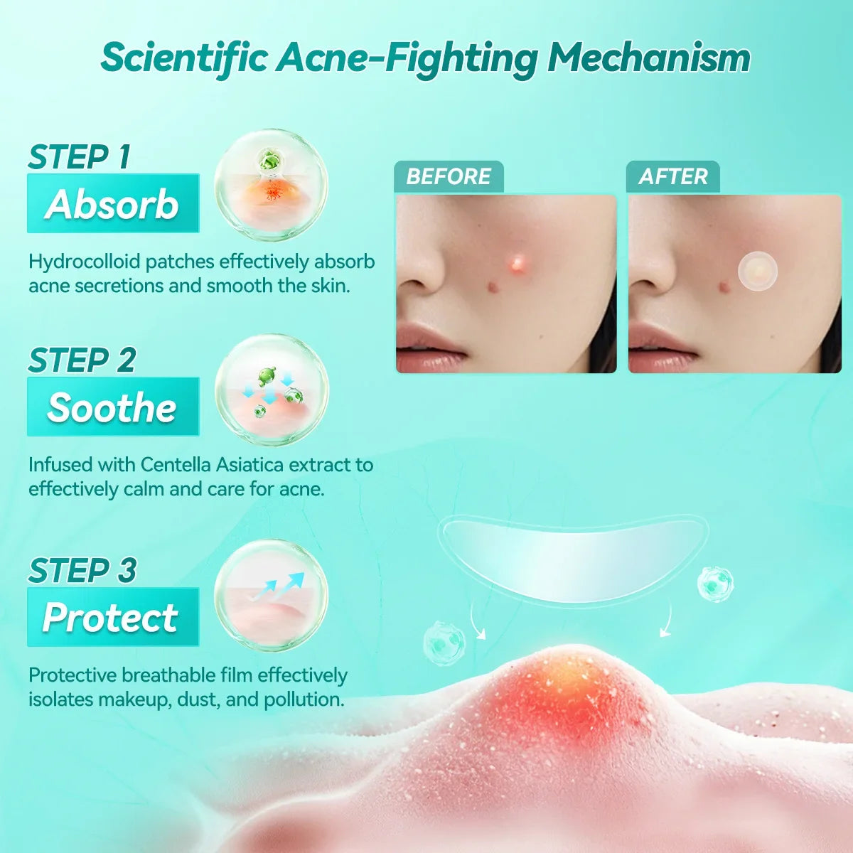 LANBENA Acne Pimple Patch – Invisible Blemish Stickers Daily Use