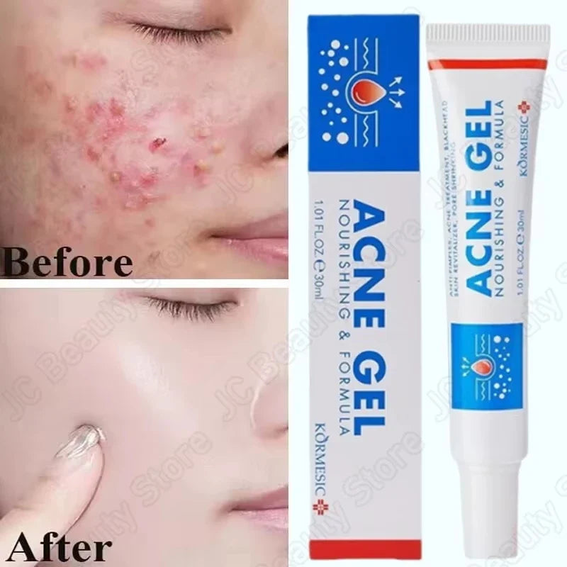 SADOER Salicylic Acid Acne Cream – Oil Control & Pore Minimizer