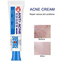 Herbal Acne Face Cream – Pore Minimizing & Skin Brightening Gel