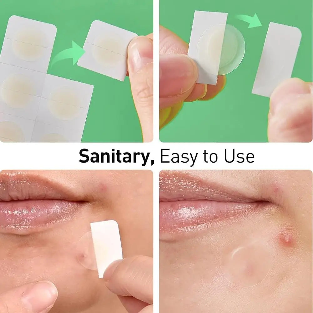 Hydrocolloid Acne Patches – Hyaluronic Acid Blemish Dots