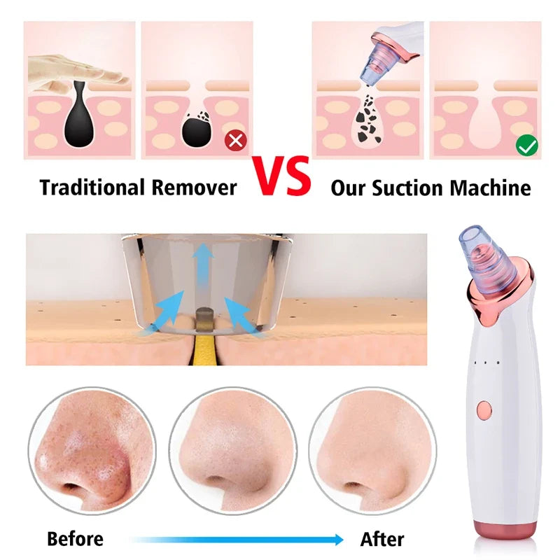 Blackhead Remover Vacuum Pore Cleanser – USB Rechargeable