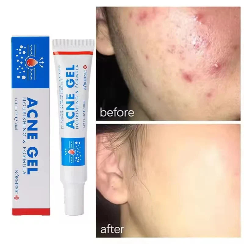 SADOER Salicylic Acid Acne Cream – Oil Control & Pore Minimizer