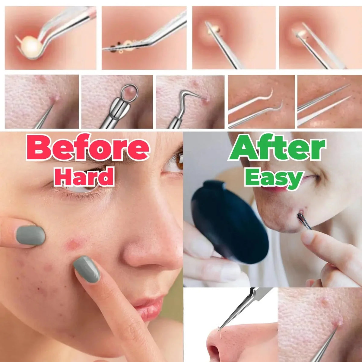 Blackhead Removal Tweezers Set – 2/3 Pcs Stainless Steel Skin Tool