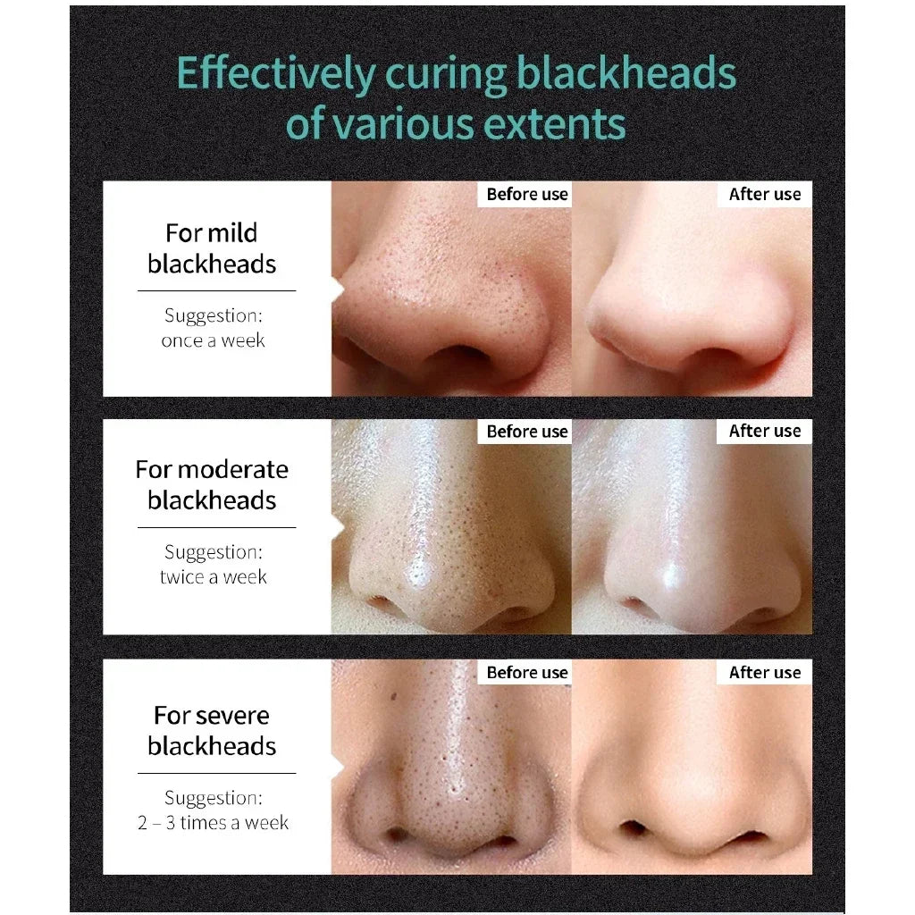 LANBENA Blackhead Remover Peel-Off Mud Mask 50g | Deep Cleanse