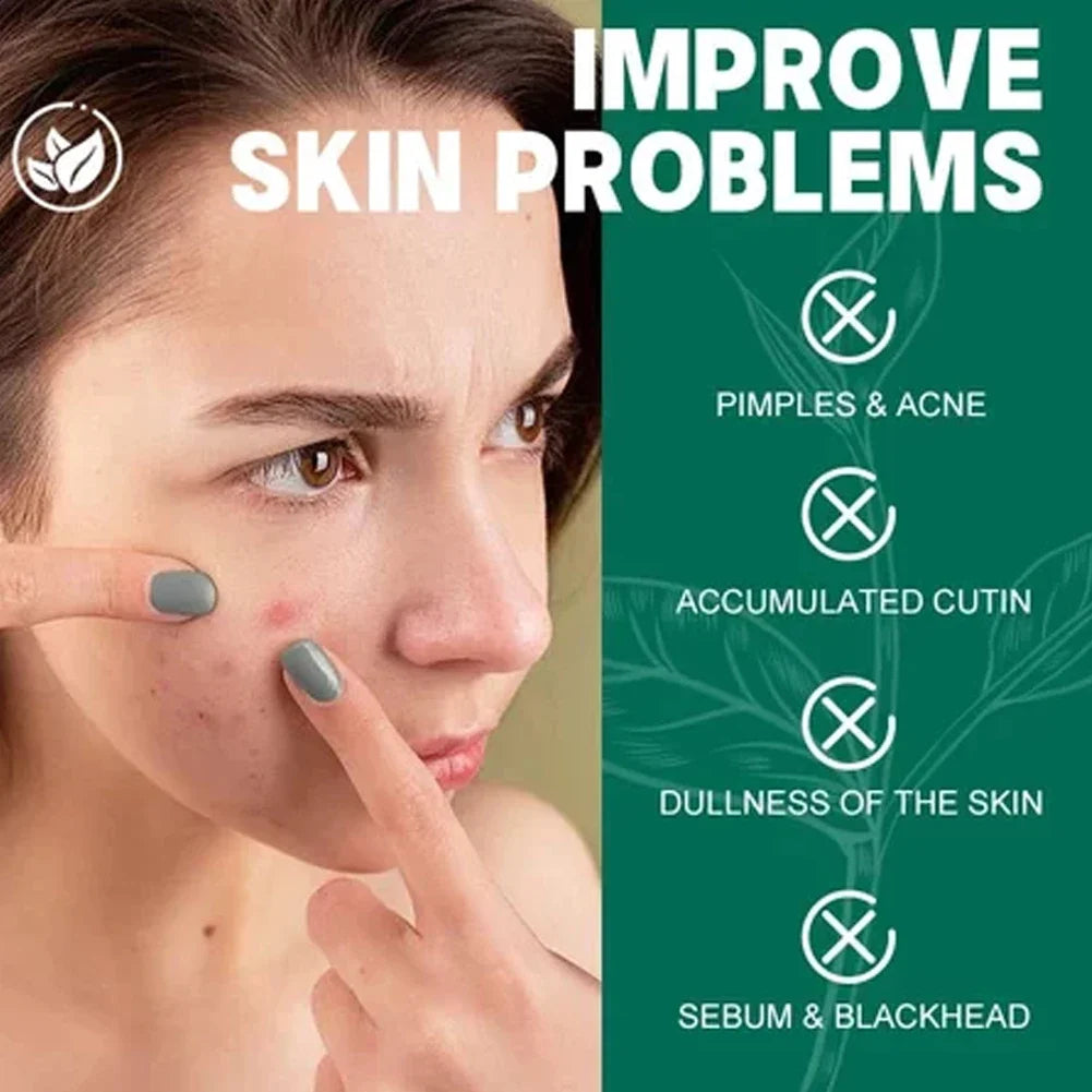 SOME BY MI 30 Days Miracle Korean Skincare Set – Acne Skin