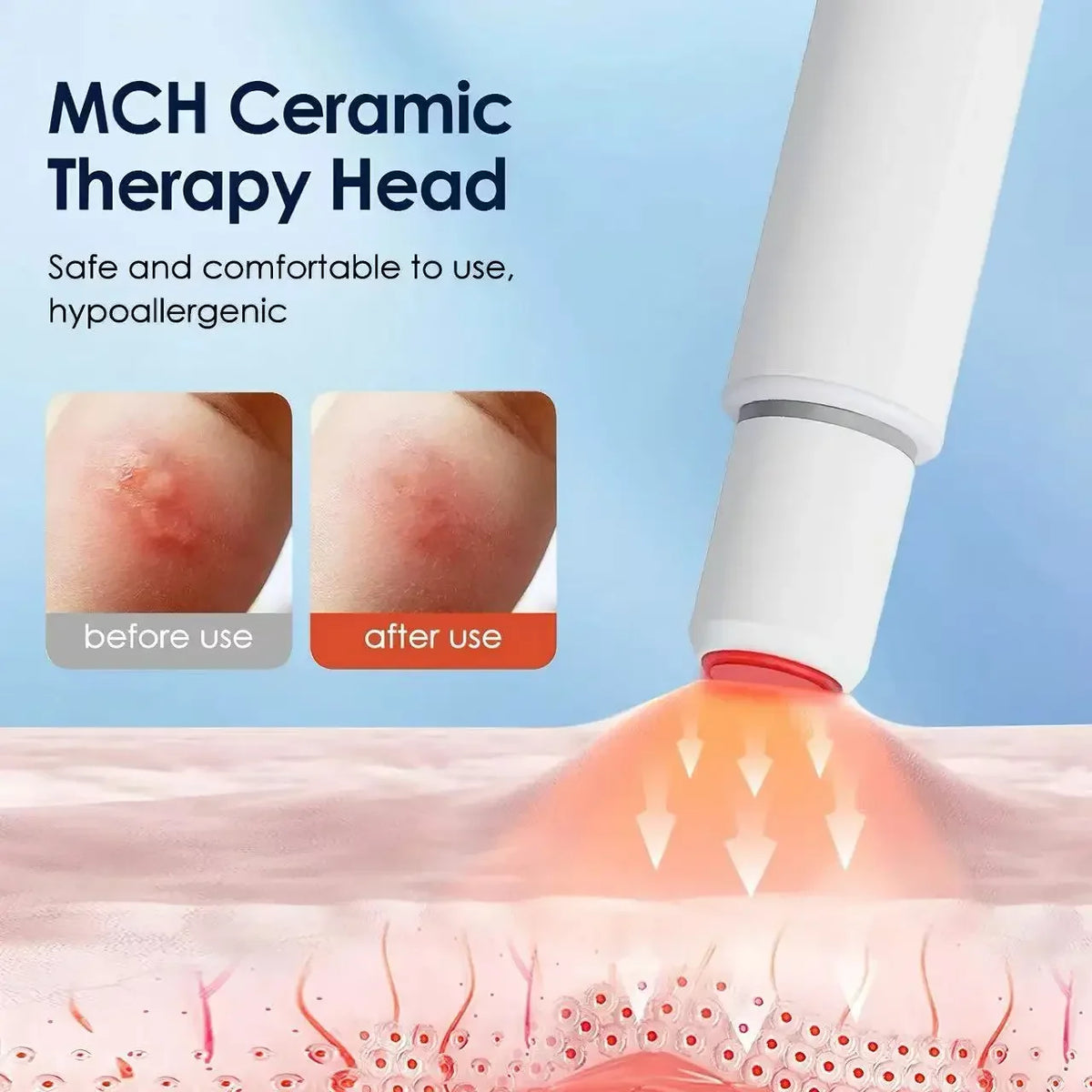 Electric Heat Therapy Itch Relief Pen | Mosquito Bite Device
