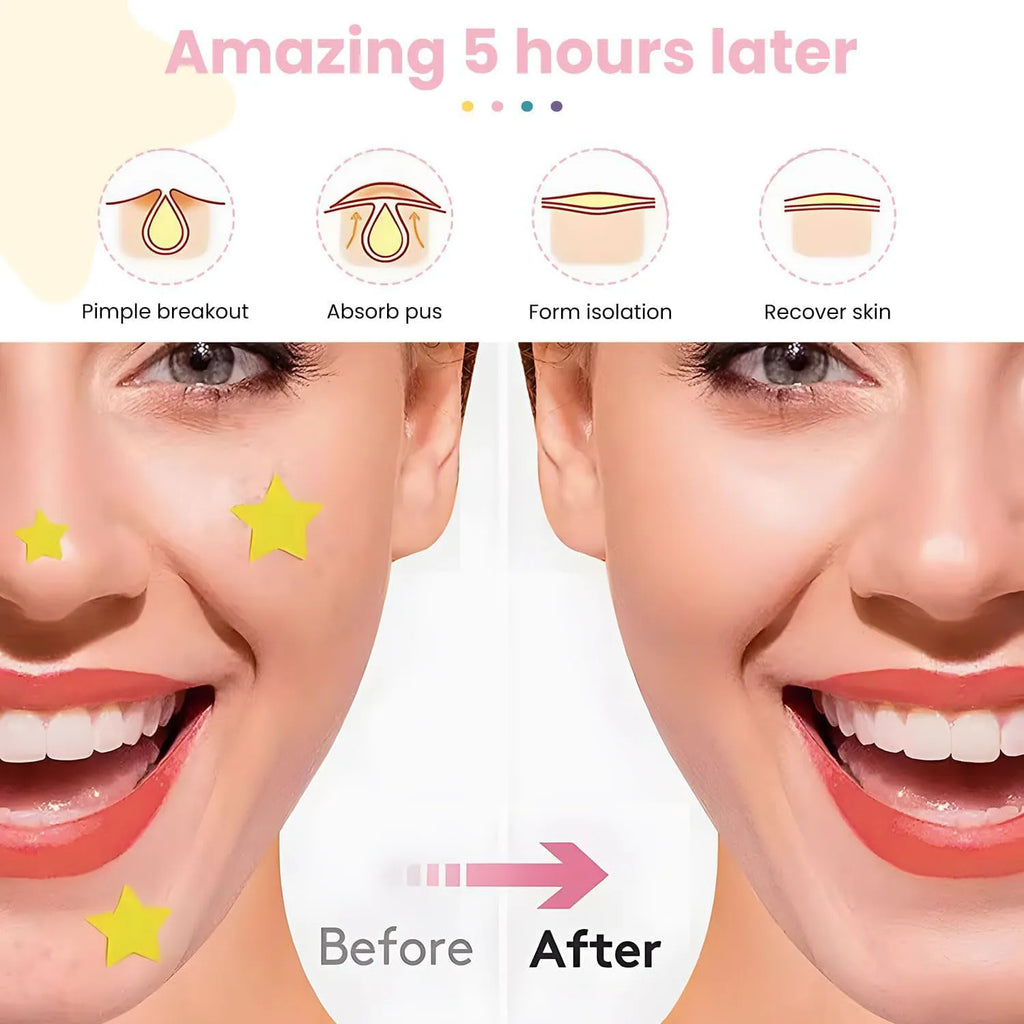 Ultra-Thin Hydrogel Acne Patches – Invisible & Waterproof