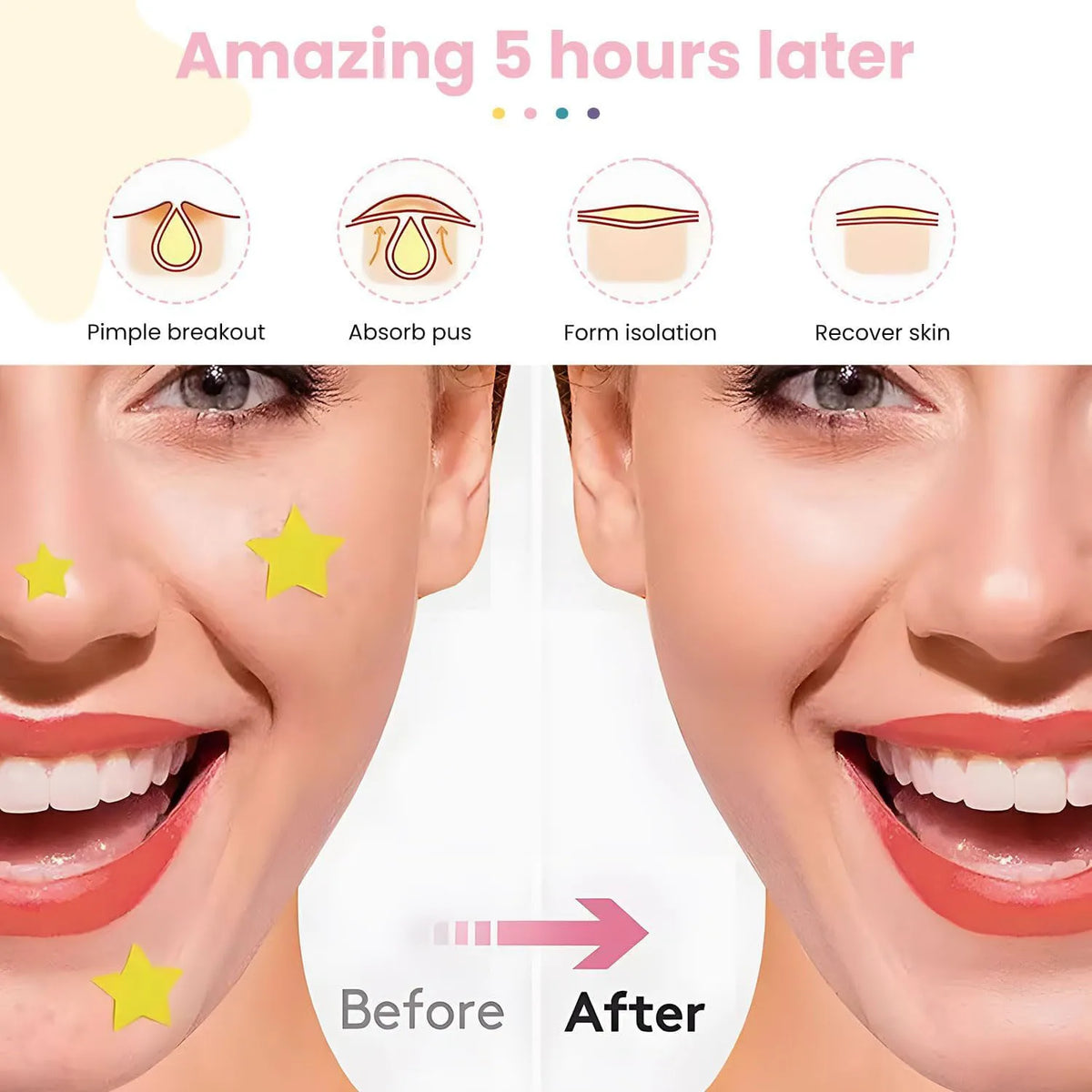 Ultra-Thin Hydrogel Acne Patches – Invisible & Waterproof