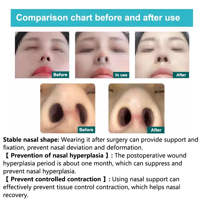 Silicone Nostril Support Clip – Nose Shaping & Breathing Aid