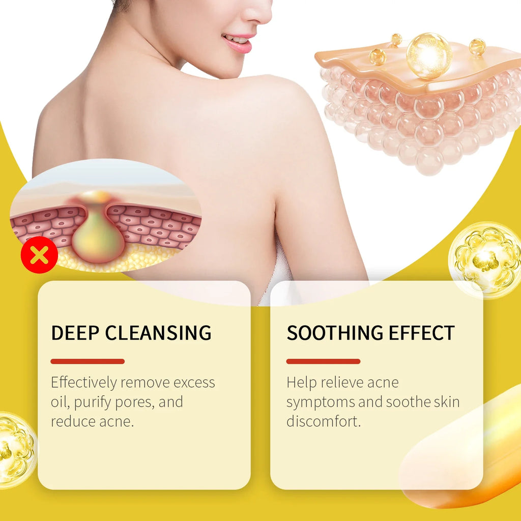 Jaysuing Acne Treatment Soap – Oil Control & Skin Lightening 100g