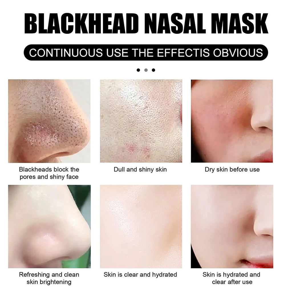 Blackhead Remover Nose Strips – Charcoal & Witch Hazel