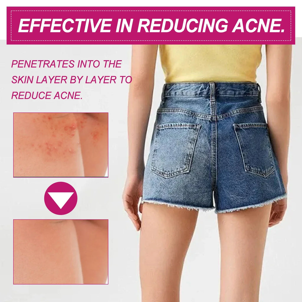 EELHOE Butt & Thigh Acne Cream – Dark Spot & Pimple Treatment