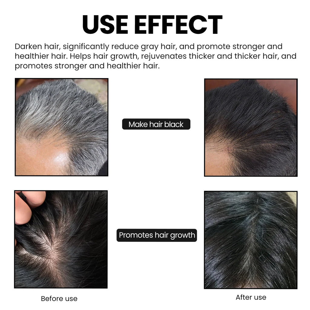 1 2 Charcoal Shampoo Soap Oily Hair Dandruff Treatment Scalp Care
