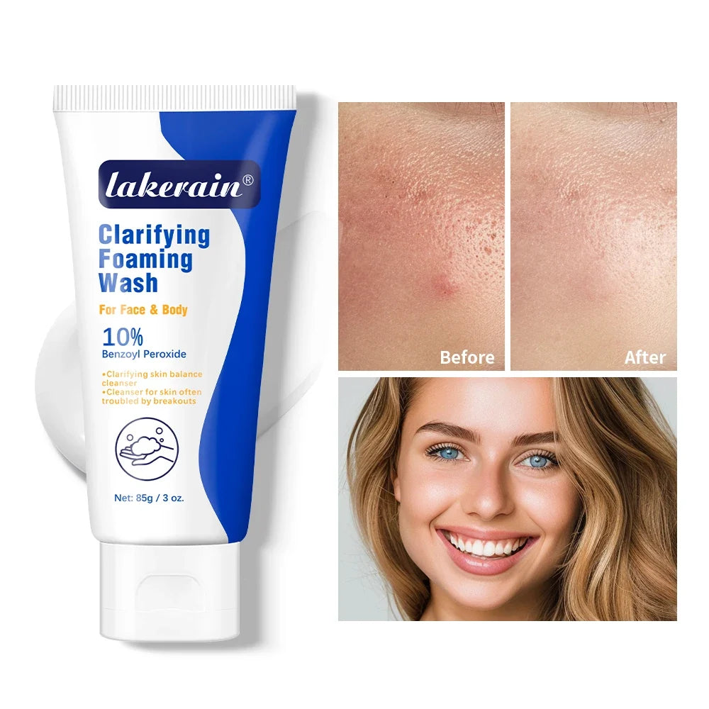 10% Benzoyl Peroxide Foaming Wash – Face & Body Cleanser