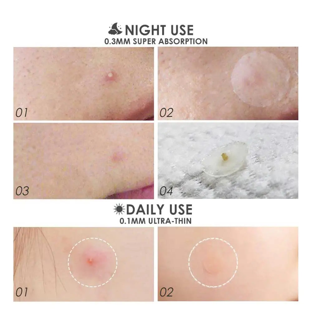 Tea Tree Pimple Patches 36ct – Spot Stickers for Face