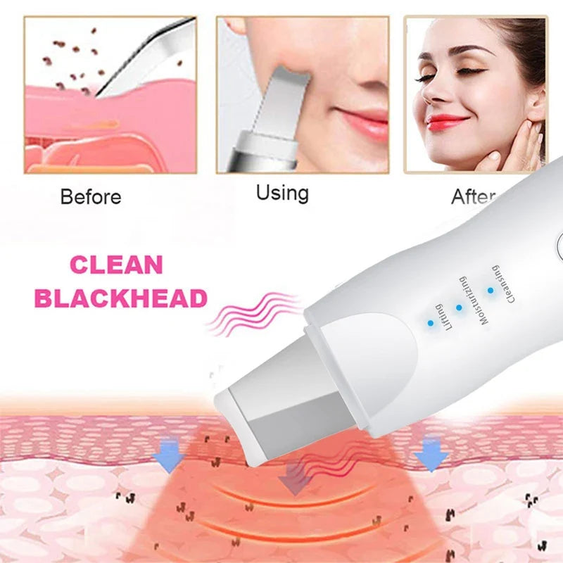 Ultrasonic Pore Scrubber – Blackhead Removal & Skin Peeling Tool