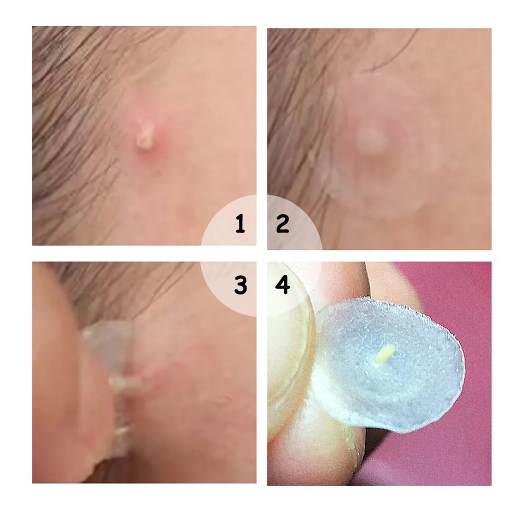 72-Piece Hydrocolloid Acne Patches – Invisible Waterproof Dots