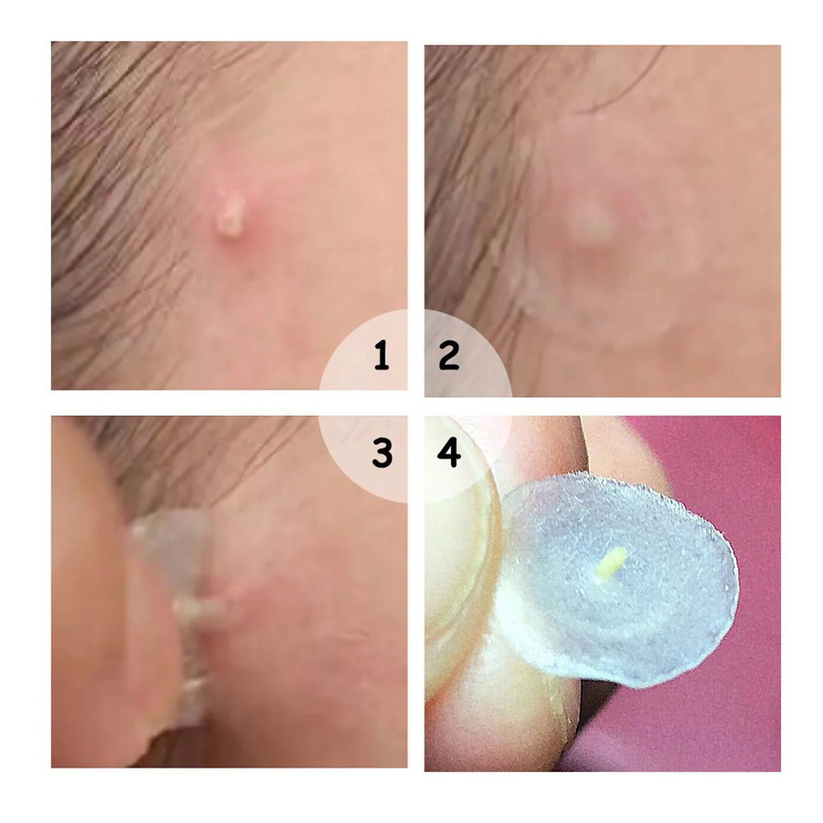 72-Piece Hydrocolloid Acne Patches – Invisible Waterproof Dots