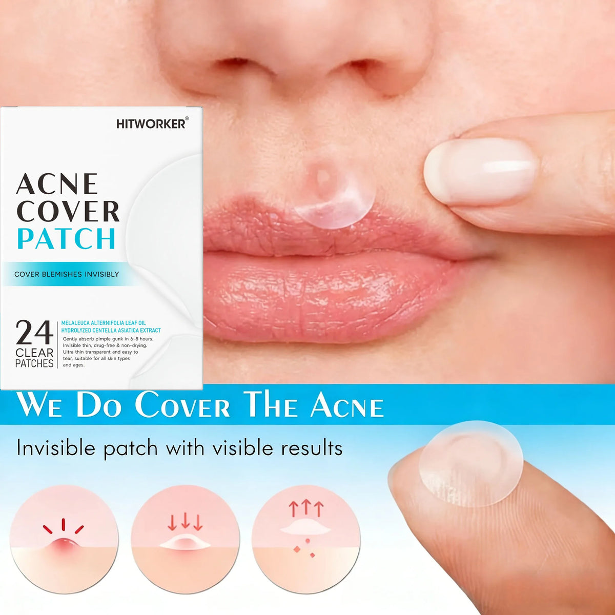 Hydrocolloid Acne Patches 24-Pack – Alcohol-Free Blemish Stickers