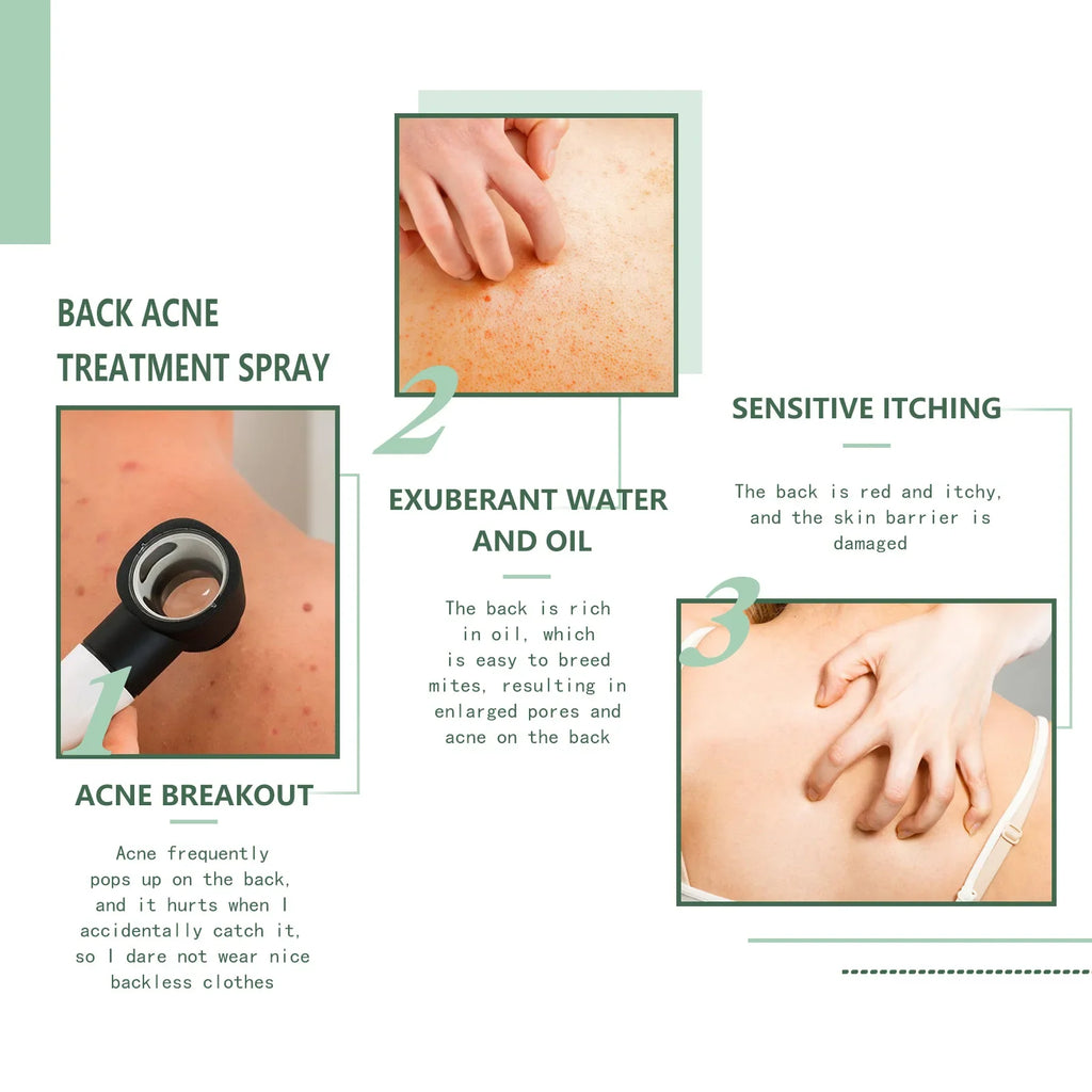 Eelhoe Back & Body Acne Repair Spray | Pore & Oil Control