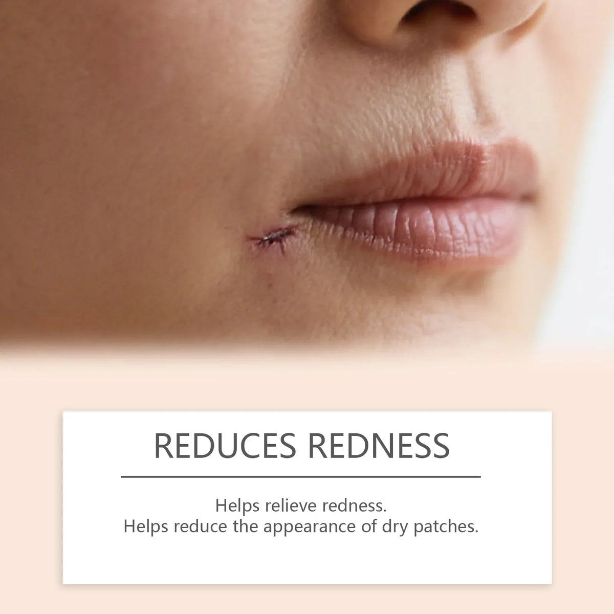 Silicone Scar Stick Acne Reducing Redness Repair Blemishes Mild
