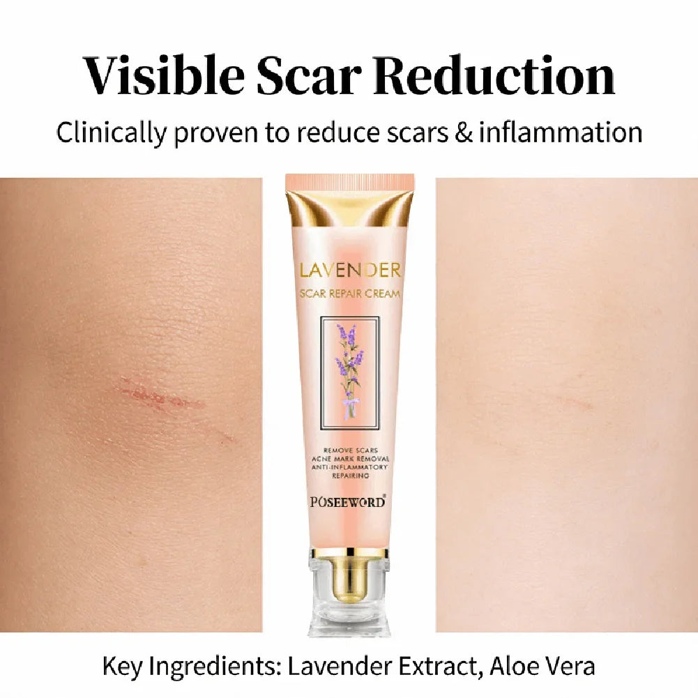 Lavender Scar Repair Cream – Fade Acne Marks & Smooth Skin