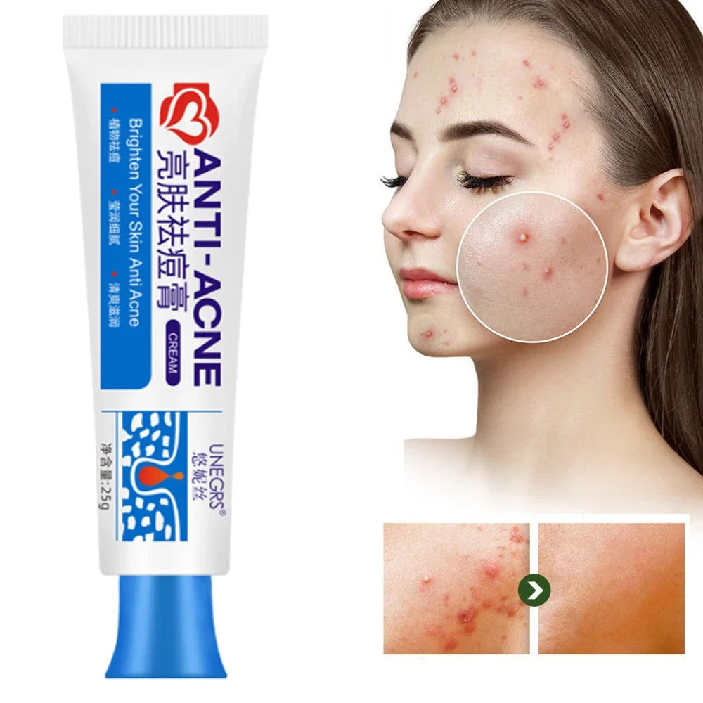 Herbal Acne Face Cream – Pore Minimizing & Skin Brightening Gel