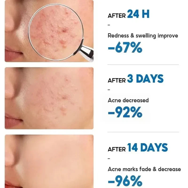 Herbal Acne Face Cream – Pore Minimizing & Skin Brightening Gel