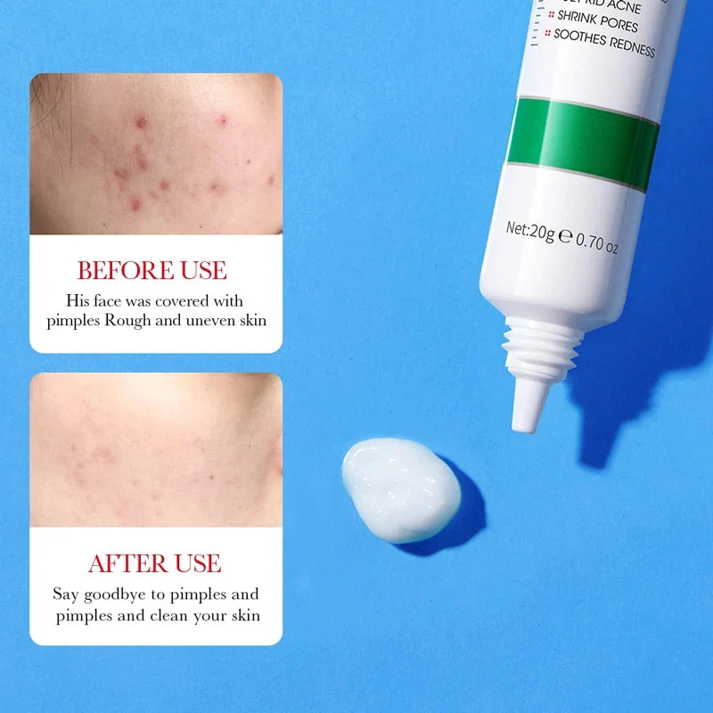 SADOER Salicylic Acid Acne Cream – Blackhead & Pore Care 20g
